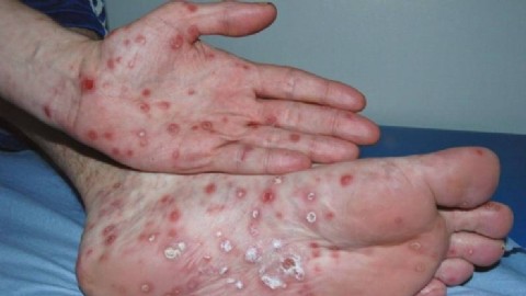 La ciudad, en alerta por el avance de la sífilis: los números que preocupan